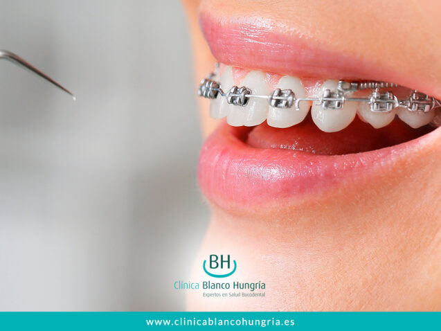 Transforma Tu Sonrisa: Beneficios de la Ortodoncia