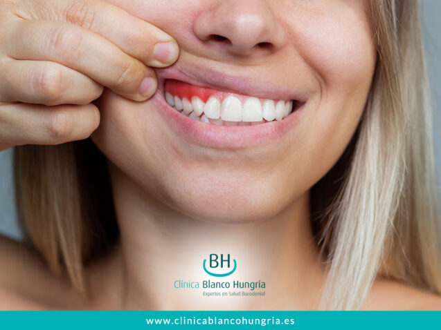 Gingivitis: Señal de Alerta para tus Encías
